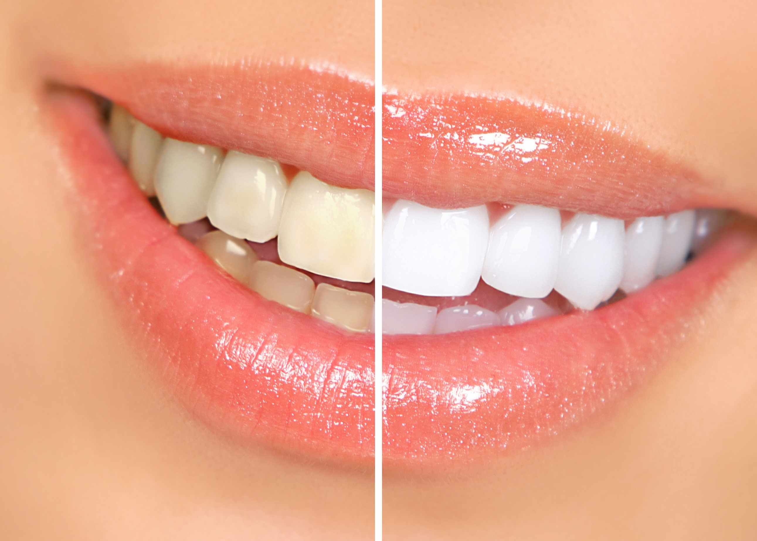 11 Questions To Ask Your Dentist About Tooth Whitening